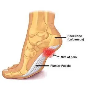 Plantar Fasciitis image 1c137887 2a37 4adf 88c7 51067c0866d1 large