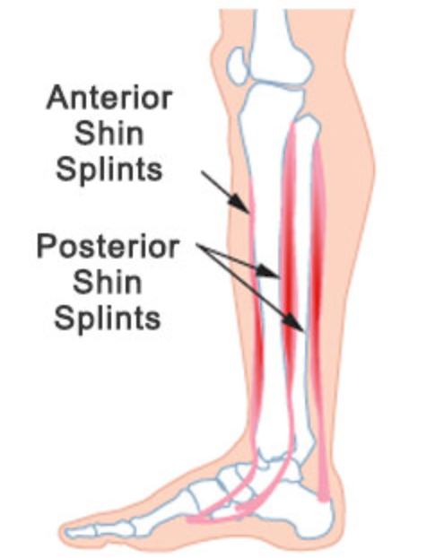 Anterior and Posterior Shin Splints