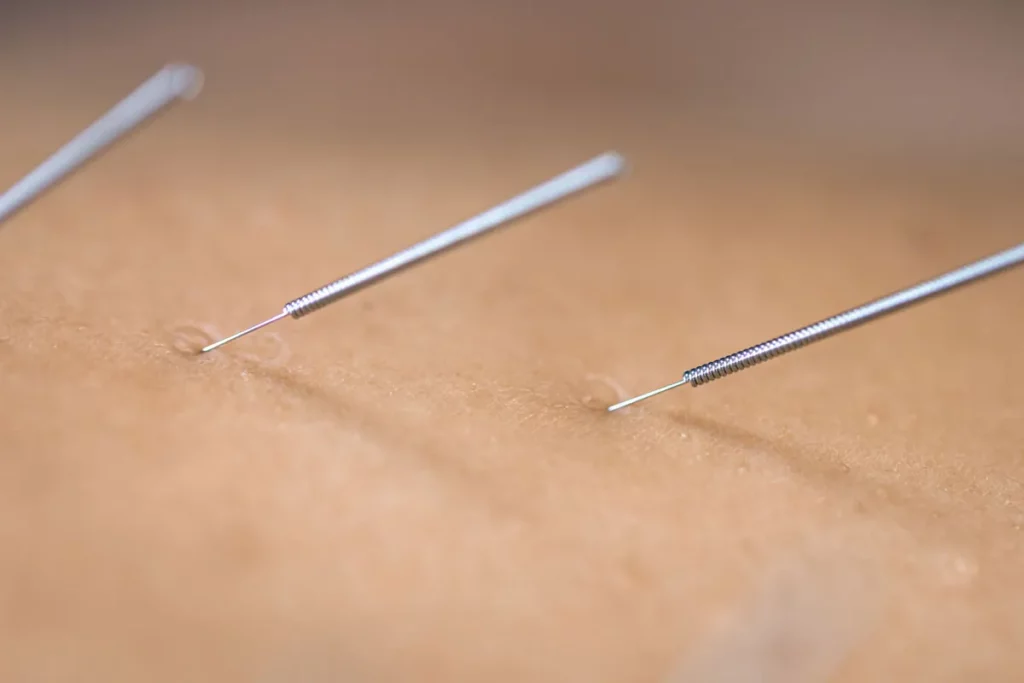 dry needling acupuncture needles on patient close 2023 11 27 04 52 40 utc